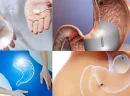 Gastrik Sleeve Ameliyatı Nedir?