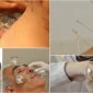Hacamatın Vakumlama Etkisi Nedir?